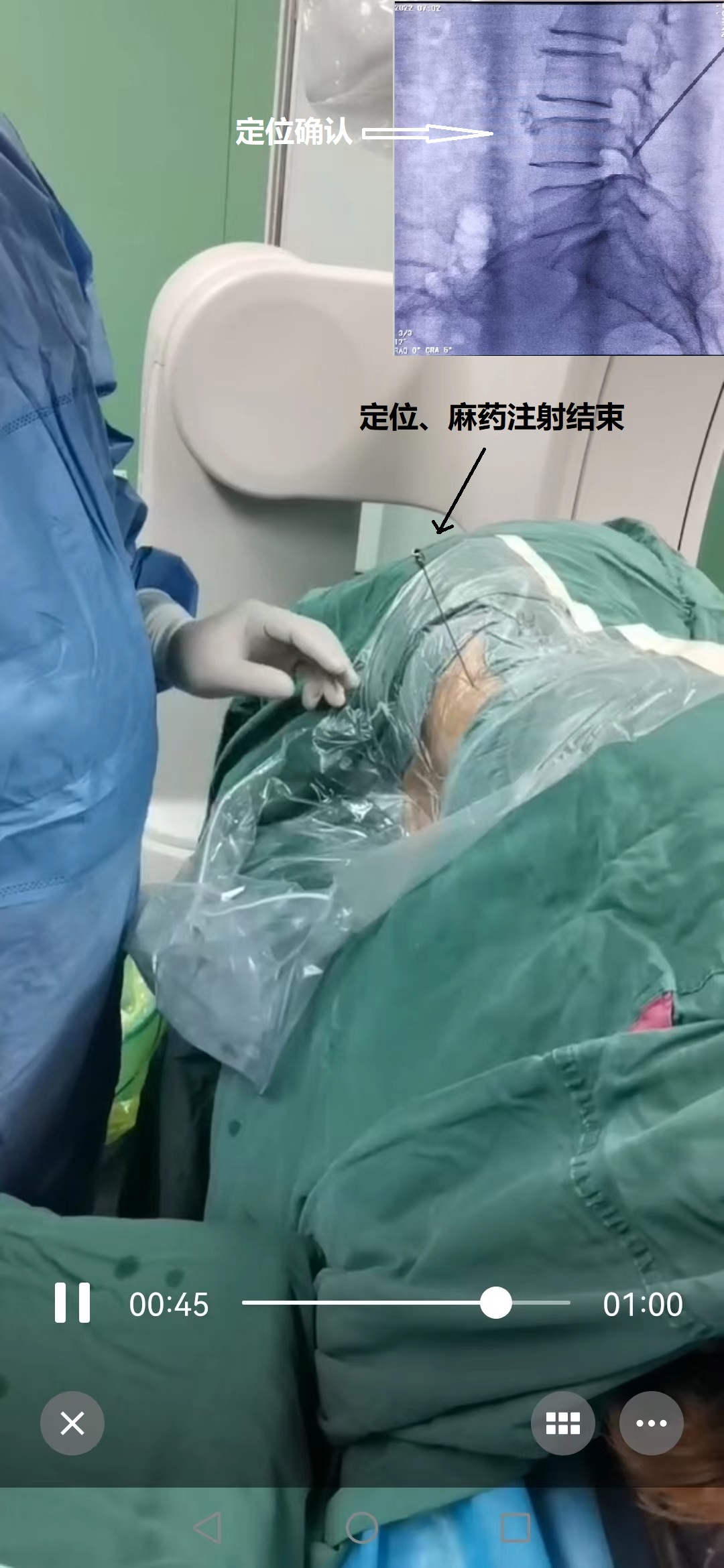 3-定位-麻藥注射結(jié)束.jpg