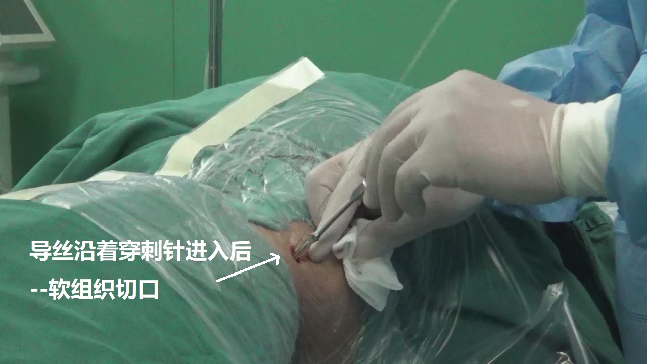 4-導(dǎo)絲進入-皮膚肌肉切口.jpg
