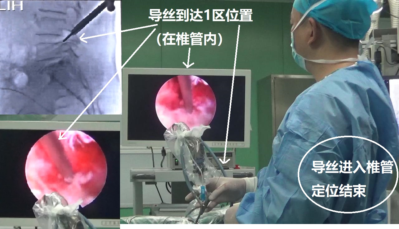 13-導(dǎo)絲到達椎管-定位結(jié)束.jpg